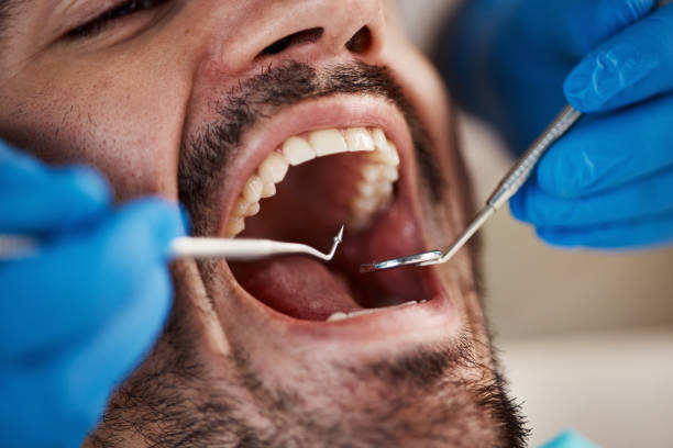 Best Emergency Tooth Extraction in Brisbane, CA